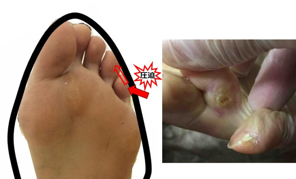 痛くないパンプス選びのコツとあしすとオススメのパンプス インソール 高知市あしすと インソール 外反母趾対策 パンプスに悩む方へ